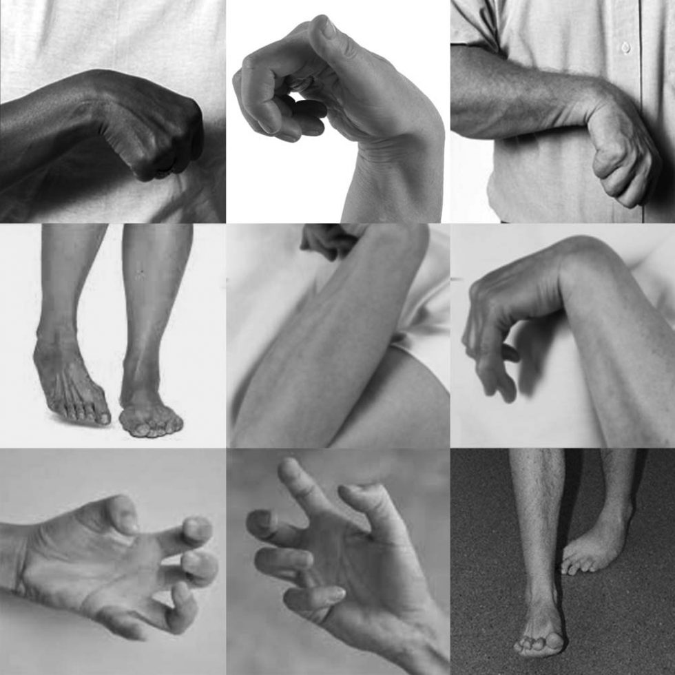 Posturing Autism Autoimmune Encephalitis in Autism