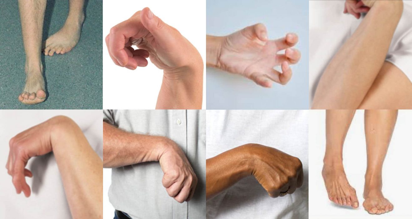 odd body posturing is common in autoimmune encephalitis and autism